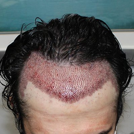 Hair Transplantation