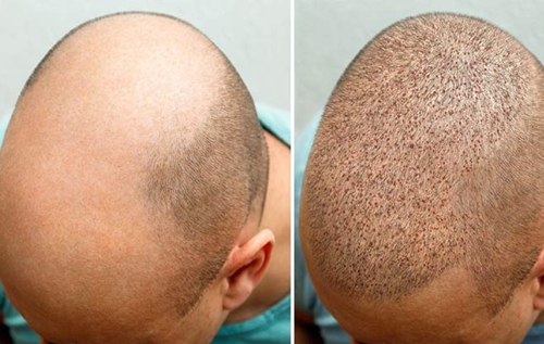 Cost of Hair Transplant