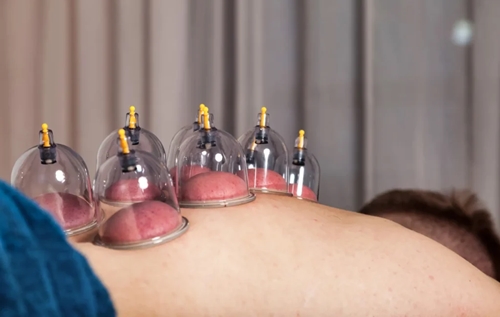 Cupping Therapy