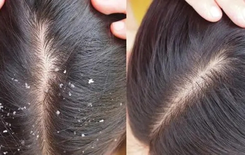 Dandruff Treatment