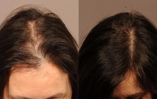 Hair Transplant in Females