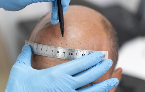 Hair Transplant in Greater Noida