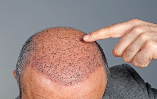 Hair Transplant in Males