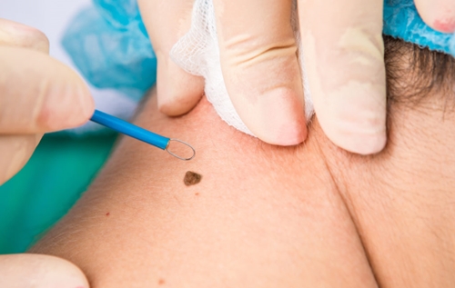 Mole & Wart Removal