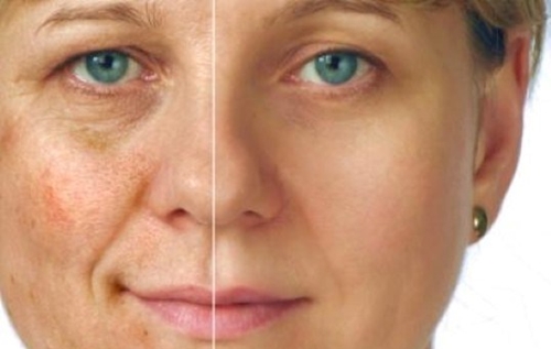 Pigmentation Treatment