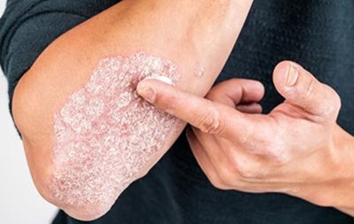 Psoriasis Treatment