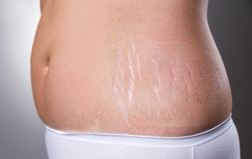 Stretch Mark Treatment