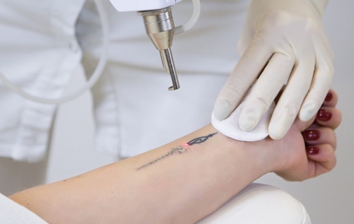 Tattoo Removal Treatment