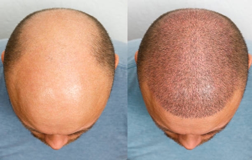 What is Hair Transplant?