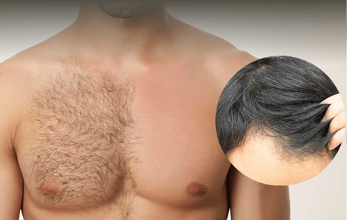 Body Hair Transplant