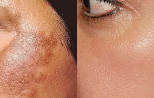 Laser For Acne & Scar