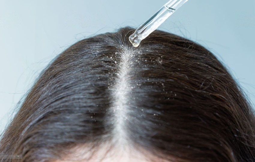 Say Goodbye to Dandruff: Best Treatments for a Healthy Scalp